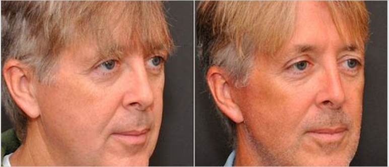 Male enhancement plastic surgery